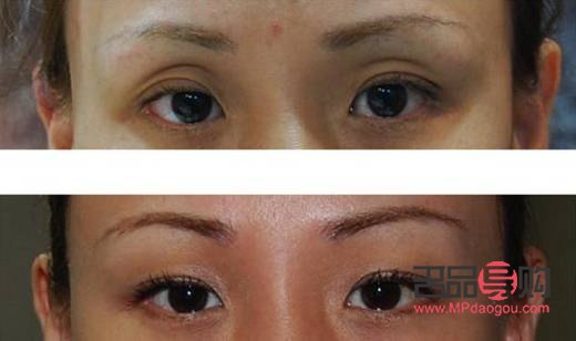 眼眶凹陷怎么恢復(fù)飽滿 中醫(yī)治療(眼眶凹陷怎么恢復(fù)飽滿 中醫(yī)治療方法)