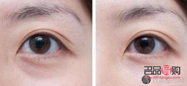 眼眶凹陷怎么恢復(fù)飽滿 中醫(yī)治療(眼眶凹陷怎么恢復(fù)飽滿 中醫(yī)治療方法)