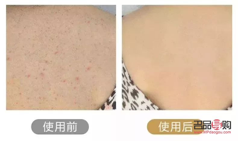 身體毛囊護(hù)理怎么做好(身體毛囊護(hù)理怎么做好呢)