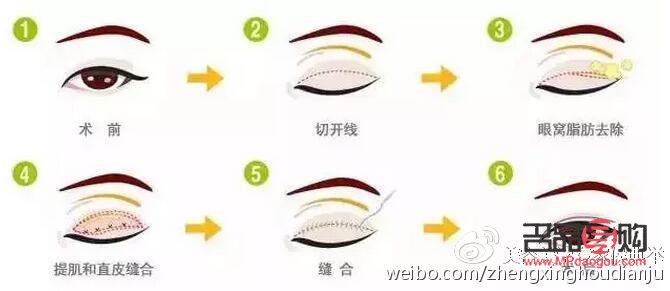 <h3>雙眼皮之美：探尋最迷人的雙眼皮魅力</h3>