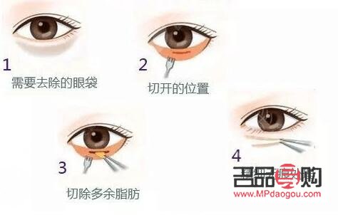 <h3>眼袋切除后是否還會再次生長？</h3>