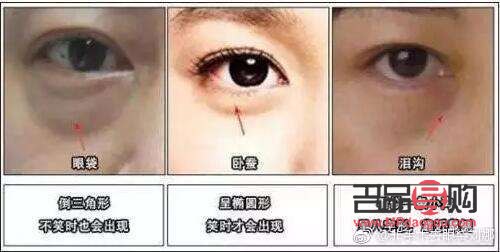 眼袋切除后是否還會(huì)再次生長(zhǎng)？