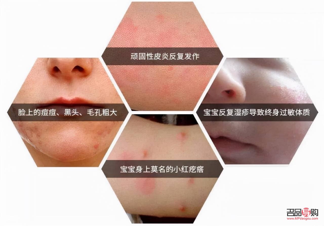 <h3>寶寶身體過敏，如何正確護(hù)理？</h3>