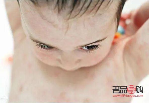 <h3>寶寶身體過敏，如何正確護(hù)理？</h3>