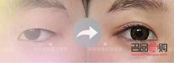 雙眼皮埋線手術(shù)效果能持續(xù)多久？