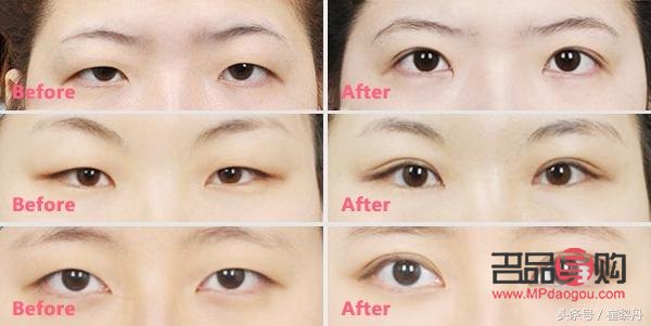腫眼泡適合做什么樣的雙眼皮手術(shù)？