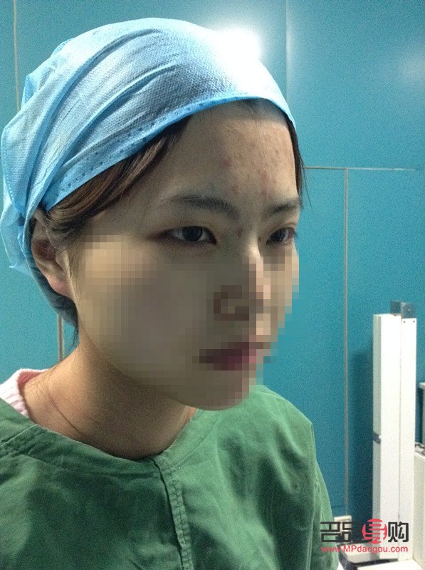 腫眼泡割雙眼皮案例(什么年齡割雙眼皮最好)