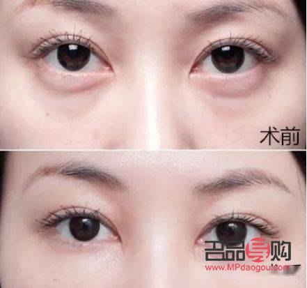 去眼袋術(shù)前術(shù)后對(duì)比照片(去眼袋手術(shù)前后圖片區(qū)別)
