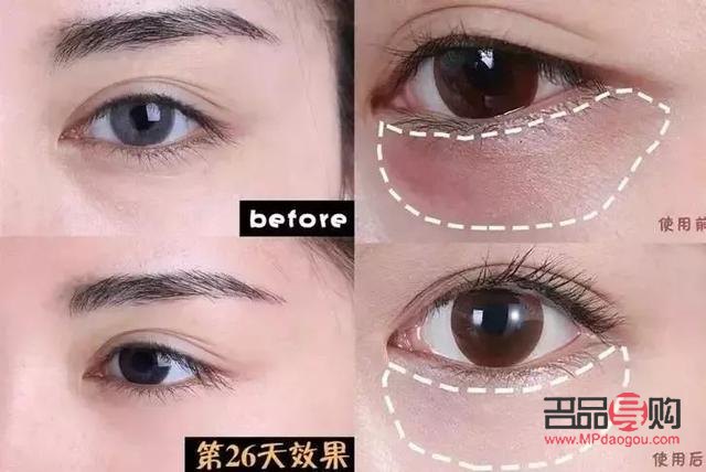 公認(rèn)最好用10大眼膜(去眼袋公認(rèn)最好用10大眼膜)