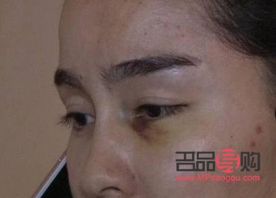 美容院怎樣除淚溝(美容院淚溝的治療方法哪種最好)