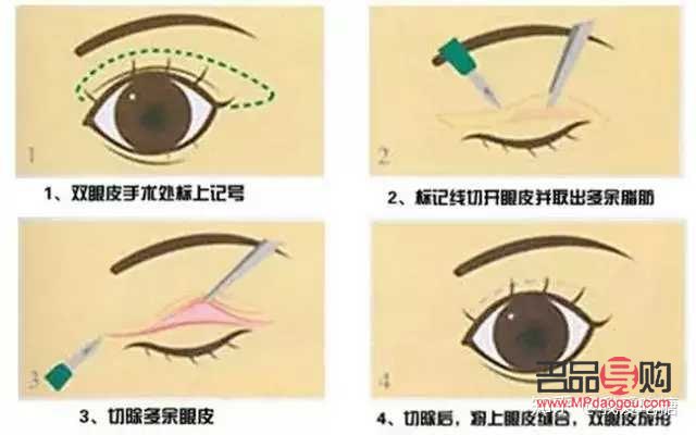 三眼皮怎么變回雙眼皮(三眼皮怎么變回雙眼皮學生)
