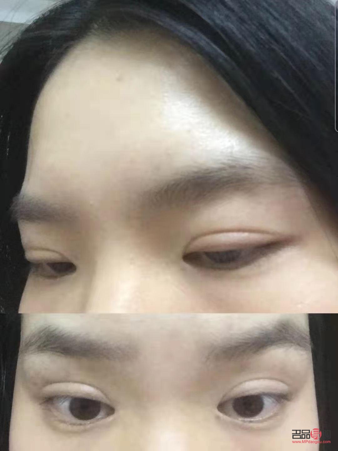 腫眼泡怎么消失(腫眼泡怎么消失了)