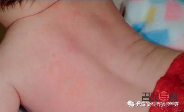 <h3>熱疹護理全攻略：守護肌膚健康，遠(yuǎn)離熱疹困擾</h3>