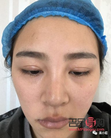 <h3>雙眼皮割窄了如何修復(fù)？專(zhuān)業(yè)指導(dǎo)與解決方案</h3>