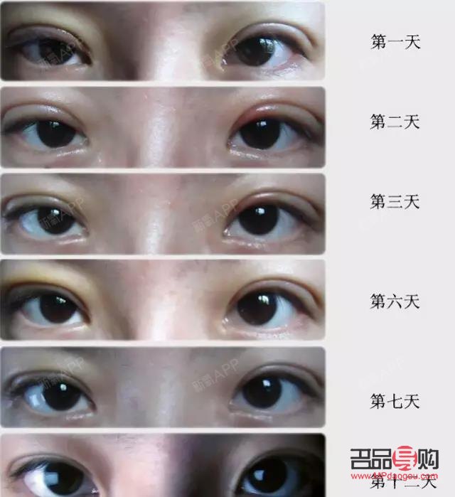 <h3>雙眼皮割窄了如何修復(fù)？專(zhuān)業(yè)指導(dǎo)與解決方案</h3>