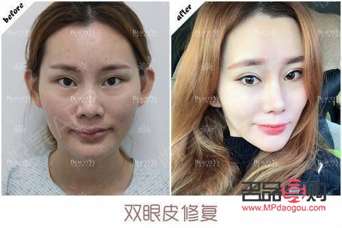 雙眼皮割窄了如何修復(fù)？專業(yè)指導(dǎo)與解決方案