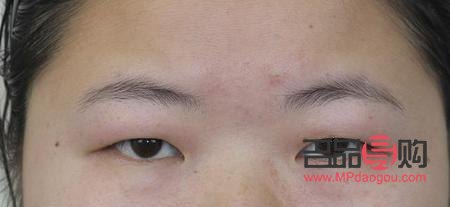 天生腫眼泡怎么快速消腫？