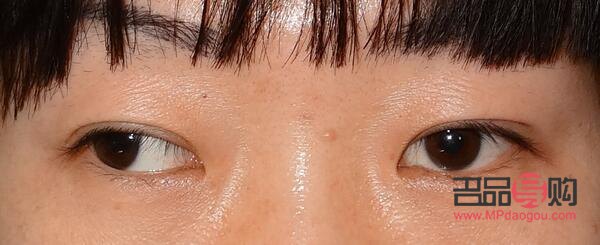 眼球偏移可以矯正嗎(眼球偏移可以矯正嗎多少錢(qián))