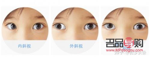 眼球偏移可以矯正嗎(眼球偏移可以矯正嗎多少錢(qián))