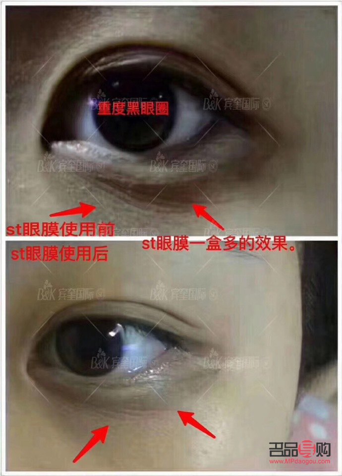 一張圖教你分辨眼袋和淚溝(一張圖教你分辨眼袋和淚溝)