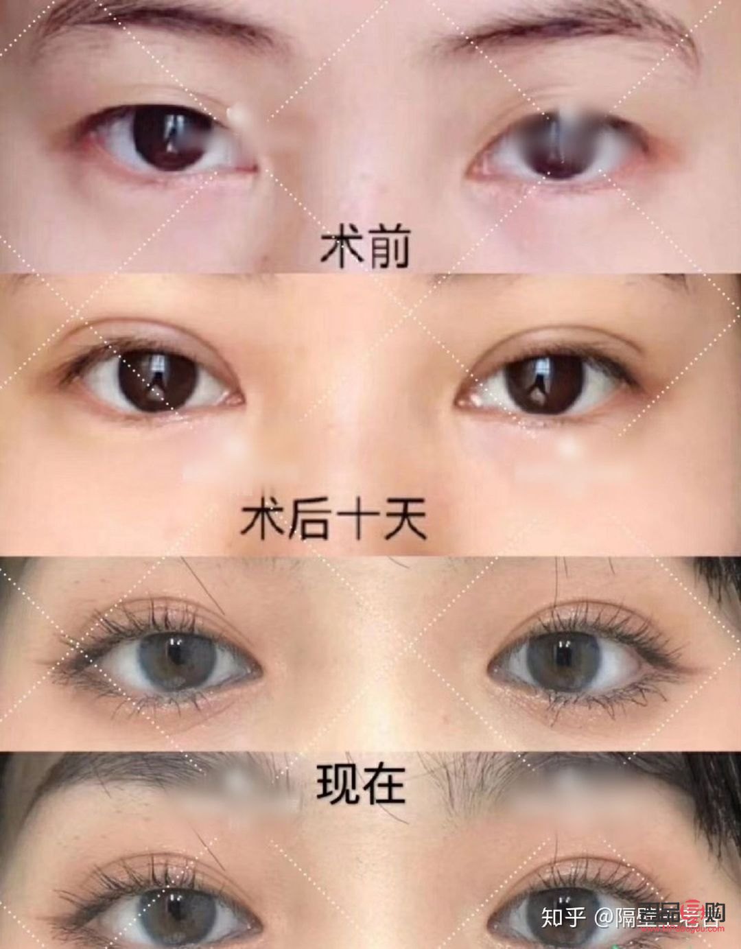 雙眼皮手術(shù)推薦(雙眼皮手術(shù)推薦醫(yī)院)