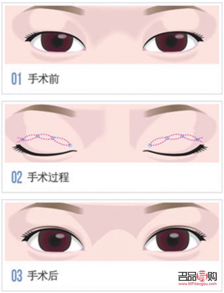 雙眼皮手術(shù)推薦(雙眼皮手術(shù)推薦醫(yī)院)