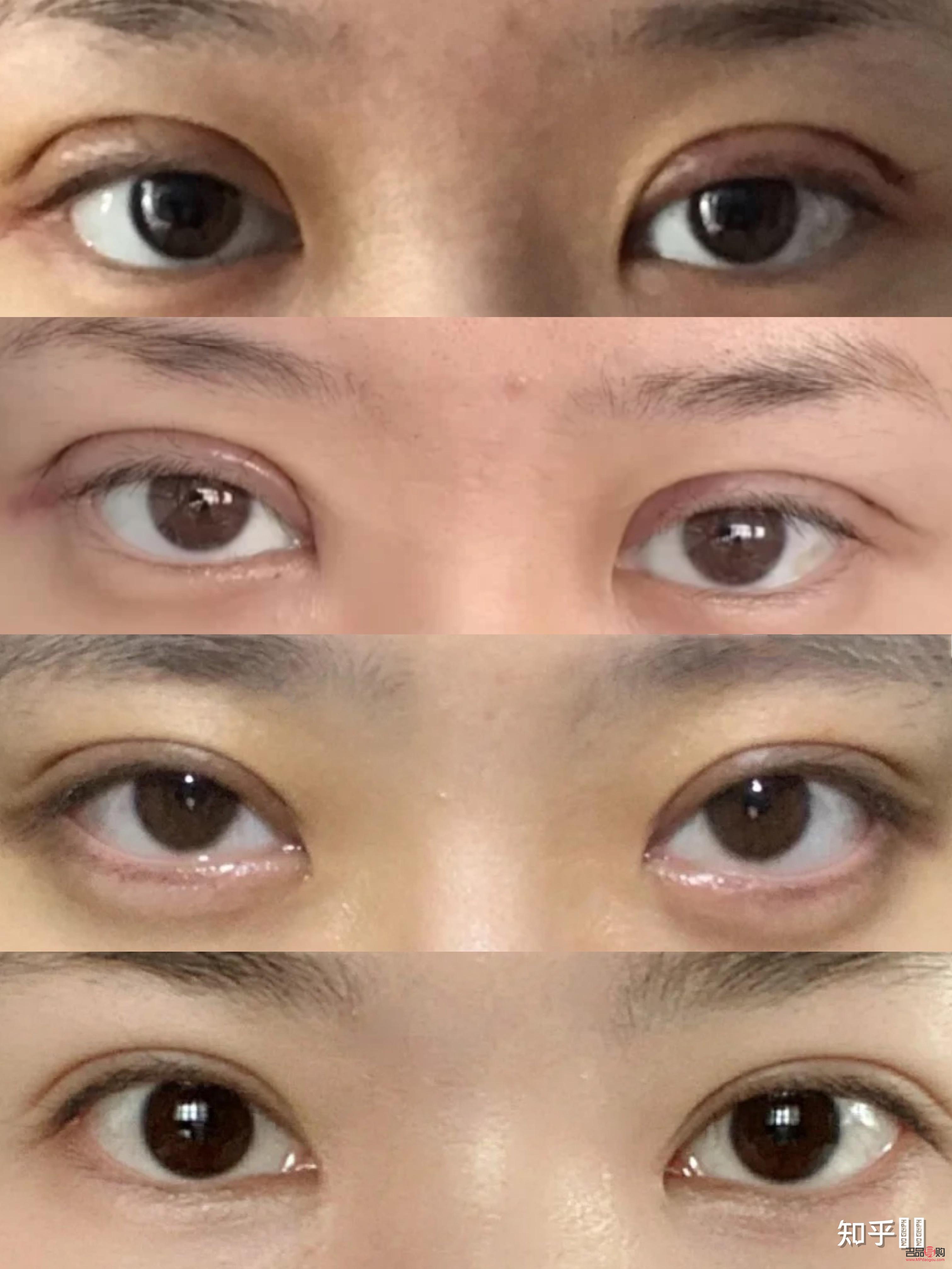 雙眼皮手術(shù)推薦(雙眼皮手術(shù)推薦醫(yī)院)