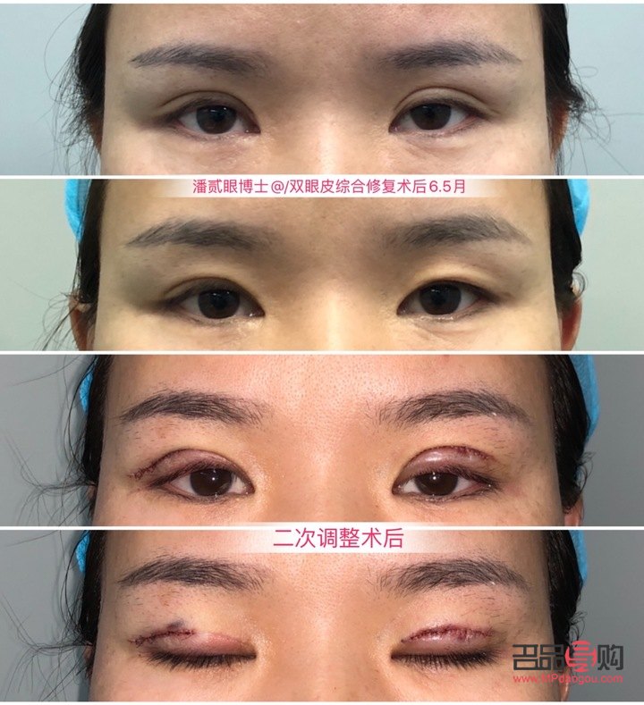 雙眼皮眼皮外翻會(huì)好嗎(雙眼皮外翻怎么辦)