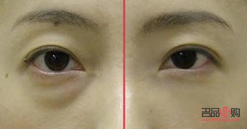 45歲的女人眼袋越來越明顯(45歲的女人眼袋越來越明顯怎么辦)