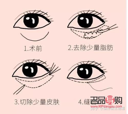 眼綜合(眼綜合手術(shù)包括什么項目)