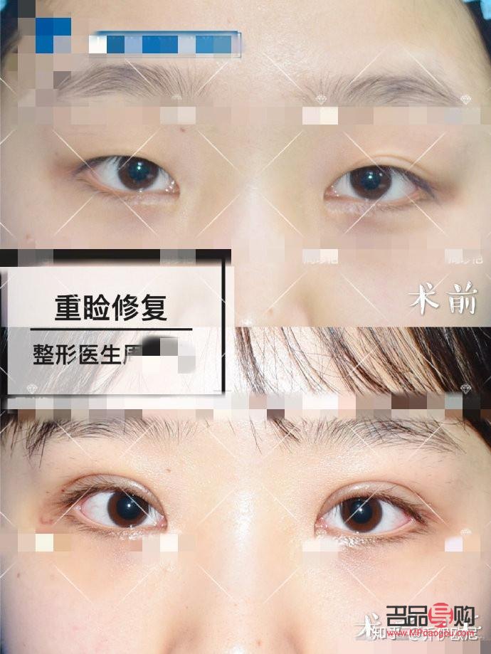 假性雙眼皮的特征(假性雙眼皮的特征圖片)