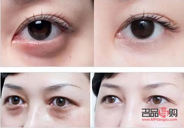 眼袋黑眼圈好重怎么辦(眼袋黑眼圈好重怎么辦圖片)