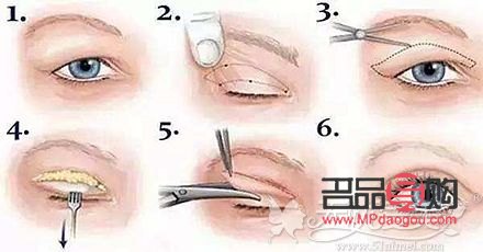 腫眼泡做抽脂手術(shù)后會(huì)再長回去嗎(腫眼泡抽脂后還會(huì)長嗎)