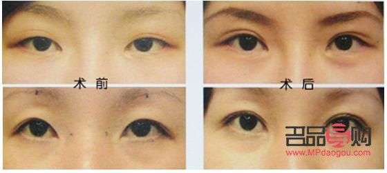 腫眼泡做抽脂手術(shù)后會(huì)再長回去嗎(腫眼泡抽脂后還會(huì)長嗎)