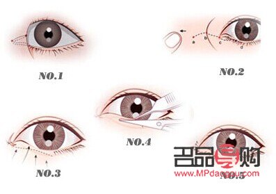 <h3>開(kāi)眼角與做雙眼皮：哪個(gè)效果更明顯？</h3>