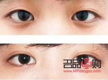 <h3>開(kāi)眼角與做雙眼皮：哪個(gè)效果更明顯？</h3>
