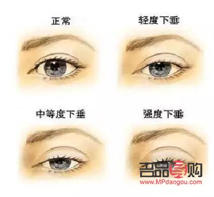 <h3>開(kāi)眼角與做雙眼皮：哪個(gè)效果更明顯？</h3>