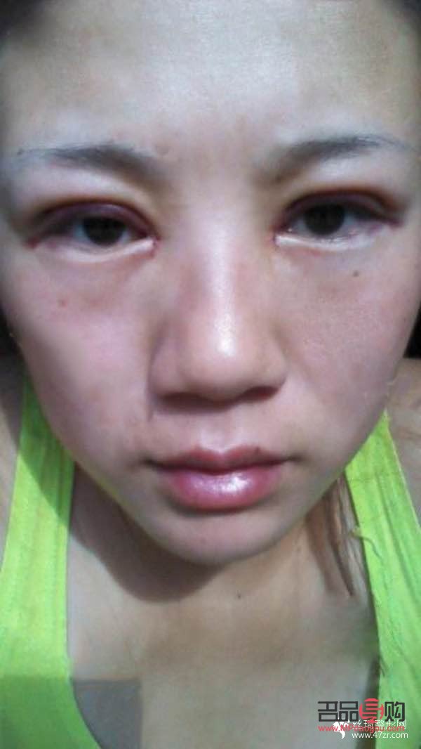 <h3>天生腫眼如何快速消腫</h3>