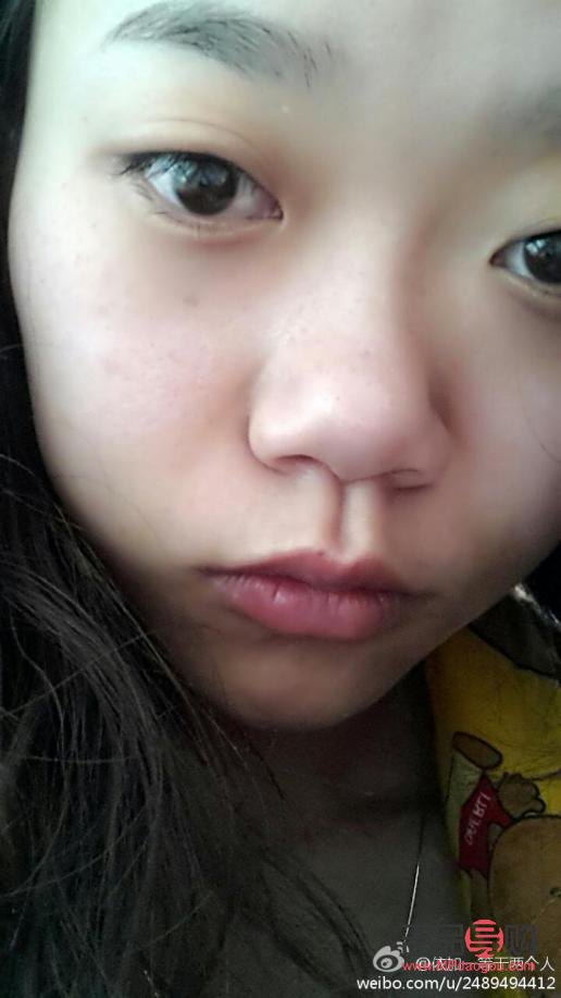 <h3>天生腫眼如何快速消腫</h3>