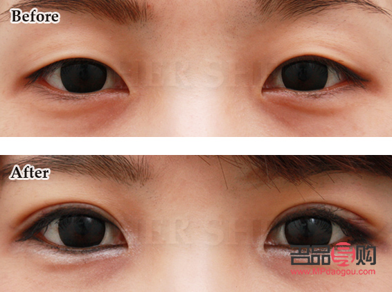 <h3>雙眼皮整形：選擇哪家醫(yī)院更靠譜？</h3>