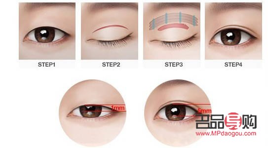 割雙眼皮對(duì)身體的影響：風(fēng)險(xiǎn)與考量