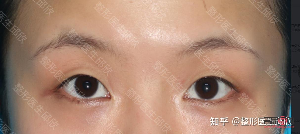 內(nèi)雙眼皮是啥樣的(內(nèi)雙眼皮是啥樣的圖片)