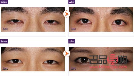 50歲眼皮下垂怎么改善(50歲眼皮下垂怎么改善圖片)