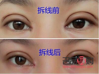 全切雙眼皮恢復(fù)之路：時(shí)間與自然的完美融合