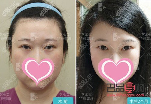 雙眼皮改單眼皮：成功案例與探索之旅