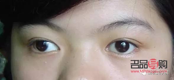 一只眼睛眼珠歪了：原因、影響與解決方案