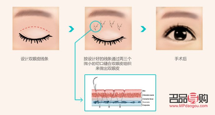 雙眼皮有幾種款式價格(雙眼皮有哪幾種款式)