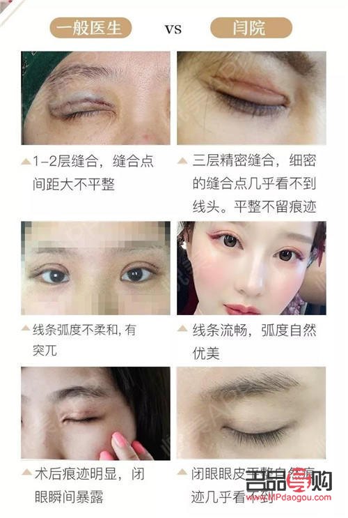 有雙眼皮可以再割嗎(有雙眼皮可以再割嗎圖片)