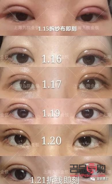 有雙眼皮可以再割嗎(有雙眼皮可以再割嗎圖片)