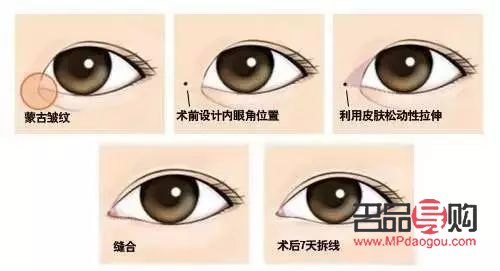 開外眼角手術(shù)前后驚艷對比